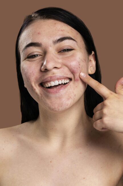 How to Naturally Treat Fungal Acne on Your Face